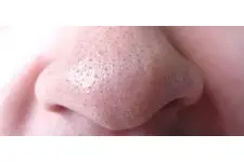 Burunda Kıl Dönmesi Belirtileri ve Tedavisi