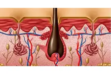 İltihaplı Kıl Dönmesi Belirtileri ve Tedavisi