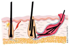 Kıl Dönmesi İltihabı Belirtileri ve Tedavisi